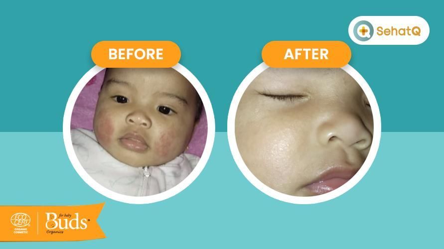 Cara Memilih Jenis Skin Care Untuk Kulit Sensitif Yang Tepat Bagi Si Kecil Budsorganics Babyempire